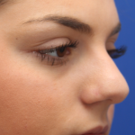 Teen Rhinoplasty Before & After Patient #16446
