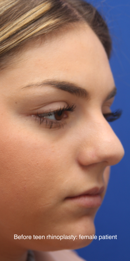 Teen Rhinoplasty Before & After Patient #16446