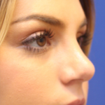 Teen Rhinoplasty Before & After Patient #16446