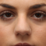 Teen Rhinoplasty Before & After Patient #16446