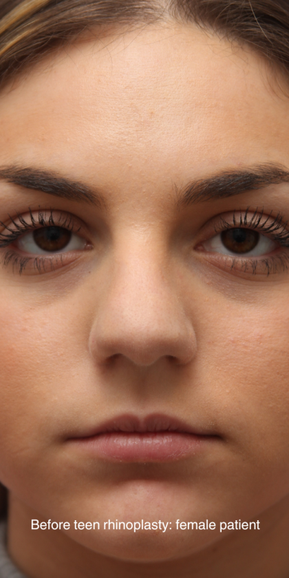 Teen Rhinoplasty Before & After Patient #16446