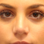 Teen Rhinoplasty Before & After Patient #16446