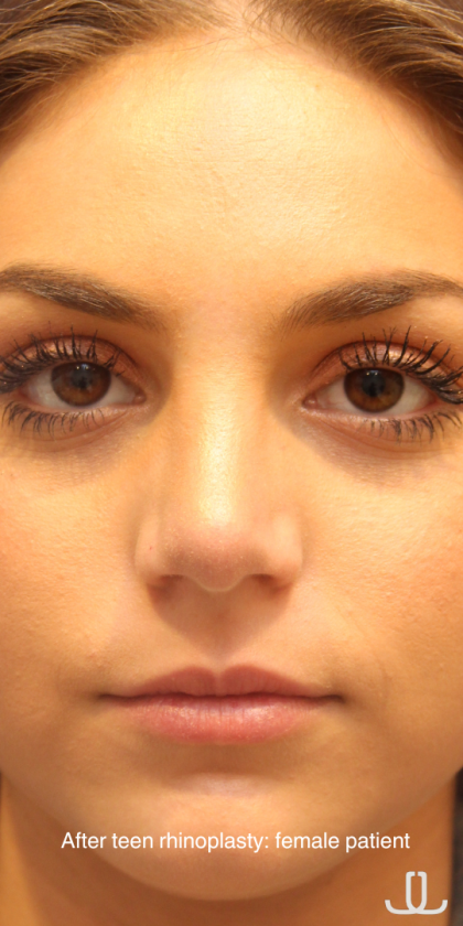 Teen Rhinoplasty Before & After Patient #16446