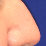 Teen Rhinoplasty Before & After Patient #16447