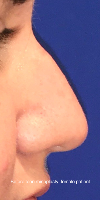 Teen Rhinoplasty Before & After Patient #16447