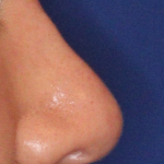 Teen Rhinoplasty Before & After Patient #16447