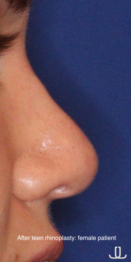 Teen Rhinoplasty Before & After Patient #16447