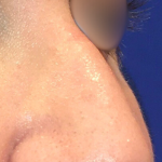 Teen Rhinoplasty Before & After Patient #16447