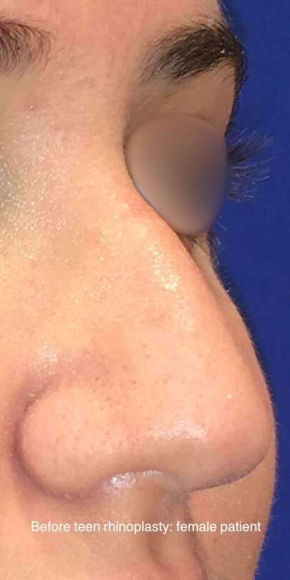 Teen Rhinoplasty Before & After Patient #16447