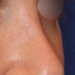 Teen Rhinoplasty Before & After Patient #16447