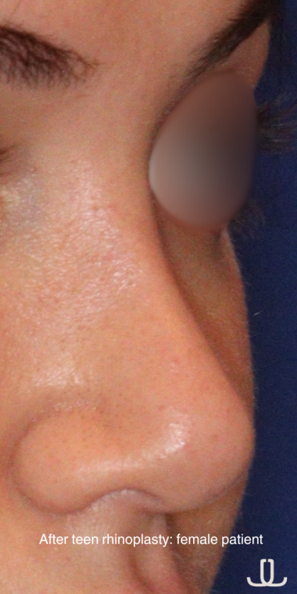 Teen Rhinoplasty Before & After Patient #16447