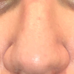 Teen Rhinoplasty Before & After Patient #16447