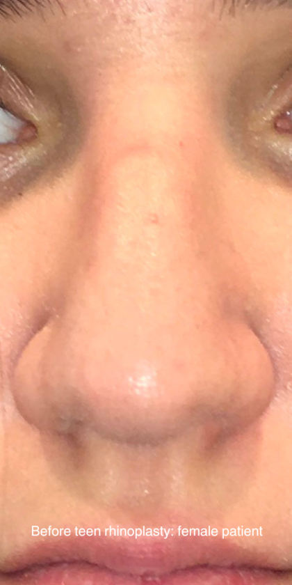 Teen Rhinoplasty Before & After Patient #16447