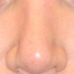 Teen Rhinoplasty Before & After Patient #16447