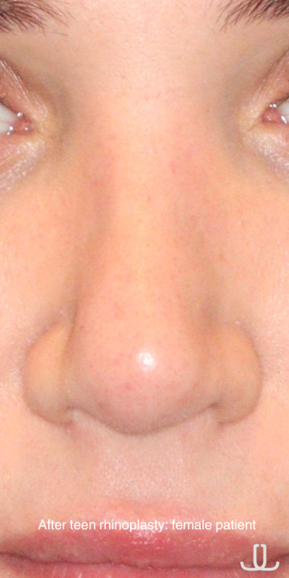 Teen Rhinoplasty Before & After Patient #16447