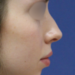 Teen Rhinoplasty Before & After Patient #16448