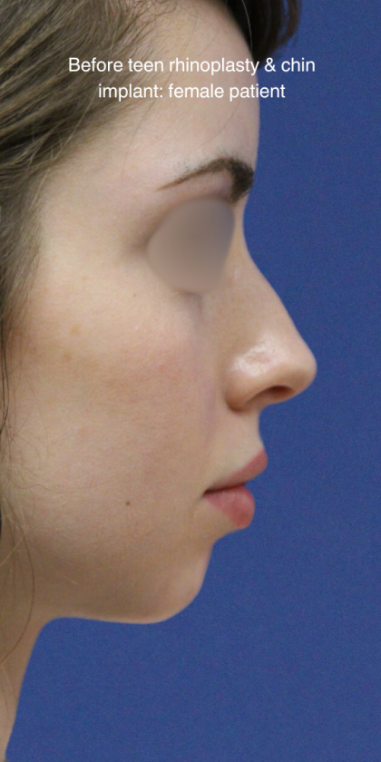 Teen Rhinoplasty Before & After Patient #16448