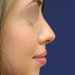 Teen Rhinoplasty Before & After Patient #16448