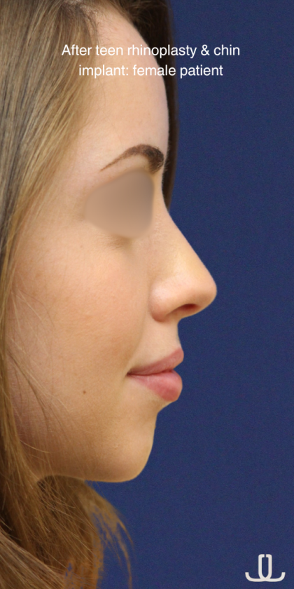 Teen Rhinoplasty Before & After Patient #16448
