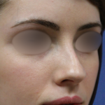 Teen Rhinoplasty Before & After Patient #16448
