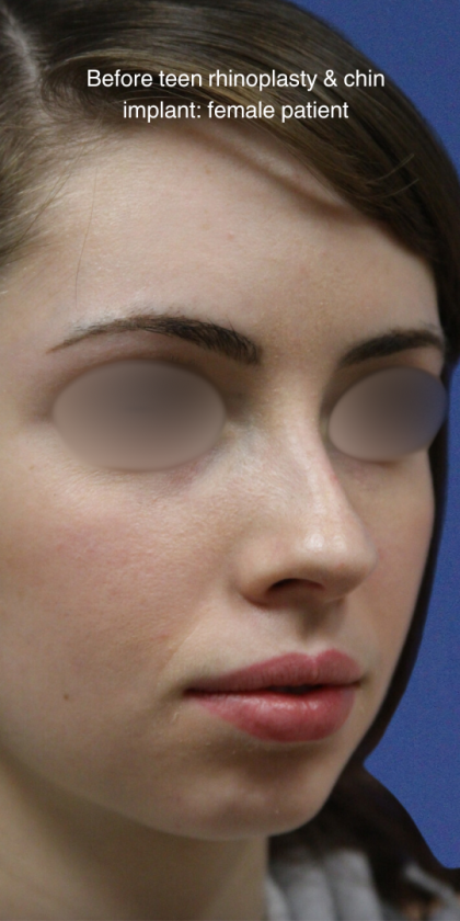 Teen Rhinoplasty Before & After Patient #16448