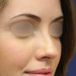 Teen Rhinoplasty Before & After Patient #16448