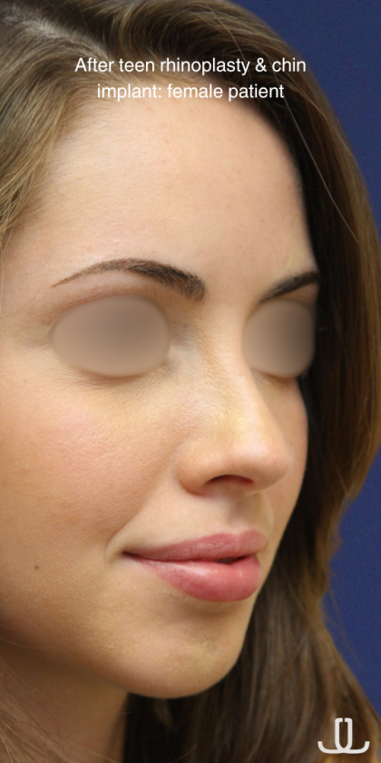 Teen Rhinoplasty Before & After Patient #16448
