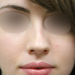 Teen Rhinoplasty Before & After Patient #16448