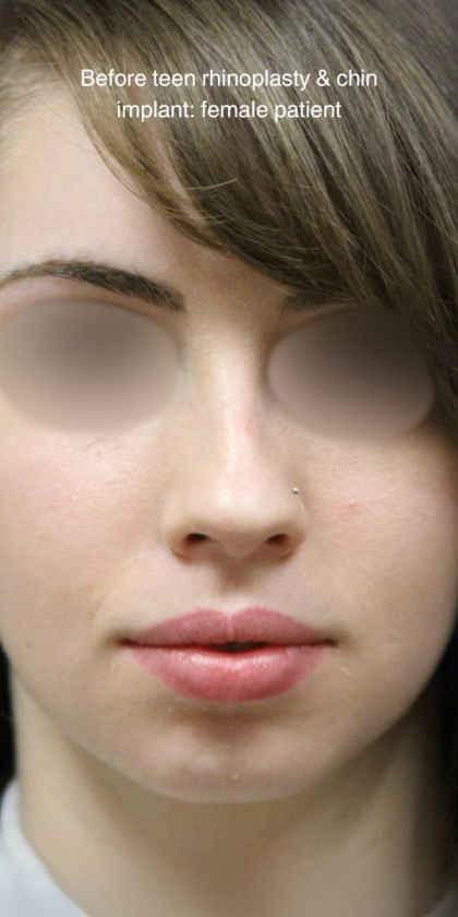 Teen Rhinoplasty Before & After Patient #16448