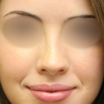 Teen Rhinoplasty Before & After Patient #16448