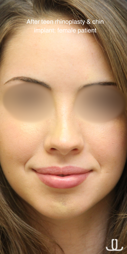 Teen Rhinoplasty Before & After Patient #16448