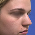 Teen Rhinoplasty Before & After Patient #16449