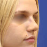 Teen Rhinoplasty Before & After Patient #16449