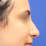 Teen Rhinoplasty Before & After Patient #16450