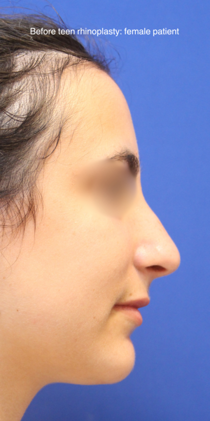 Teen Rhinoplasty Before & After Patient #16450