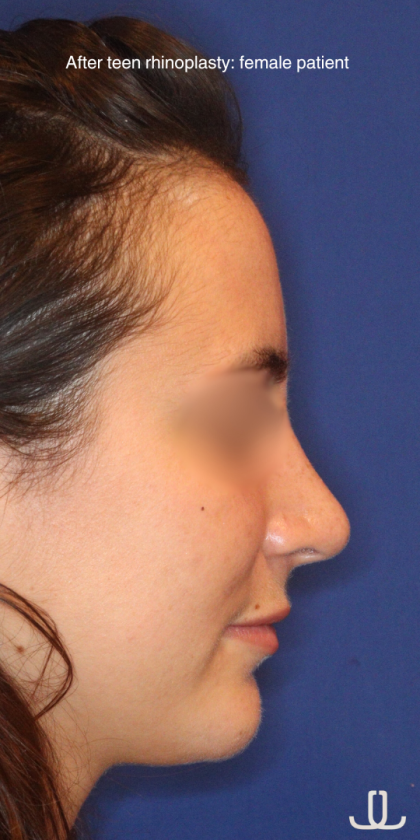 Teen Rhinoplasty Before & After Patient #16450