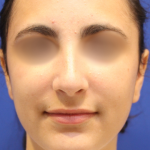 Teen Rhinoplasty Before & After Patient #16450