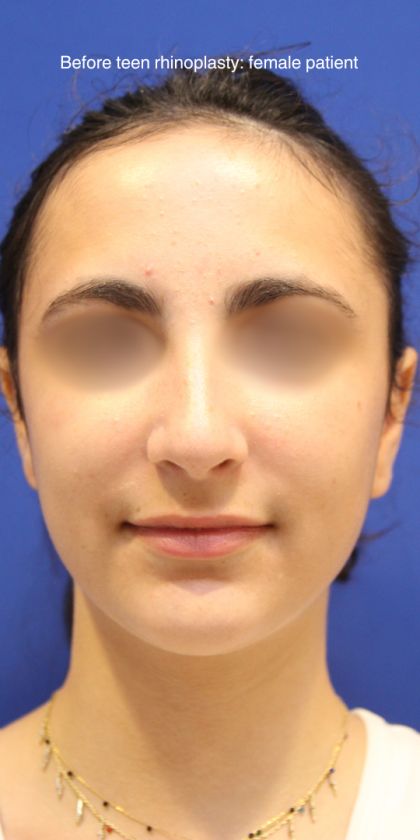 Teen Rhinoplasty Before & After Patient #16450
