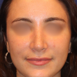 Teen Rhinoplasty Before & After Patient #16450