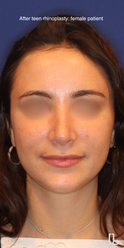 Teen Rhinoplasty Before & After Patient #16450