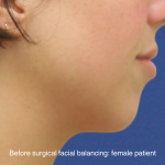 Chin Augmentation Before & After Patient #16742