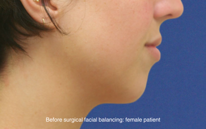 Chin Augmentation Before & After Patient #16742