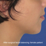 Chin Augmentation Before & After Patient #16742