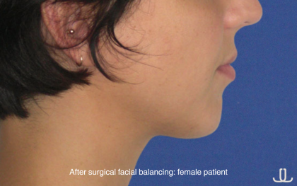 Chin Augmentation Before & After Patient #16742