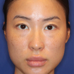 Non-Surgical Nose Job Before & After Patient #16752