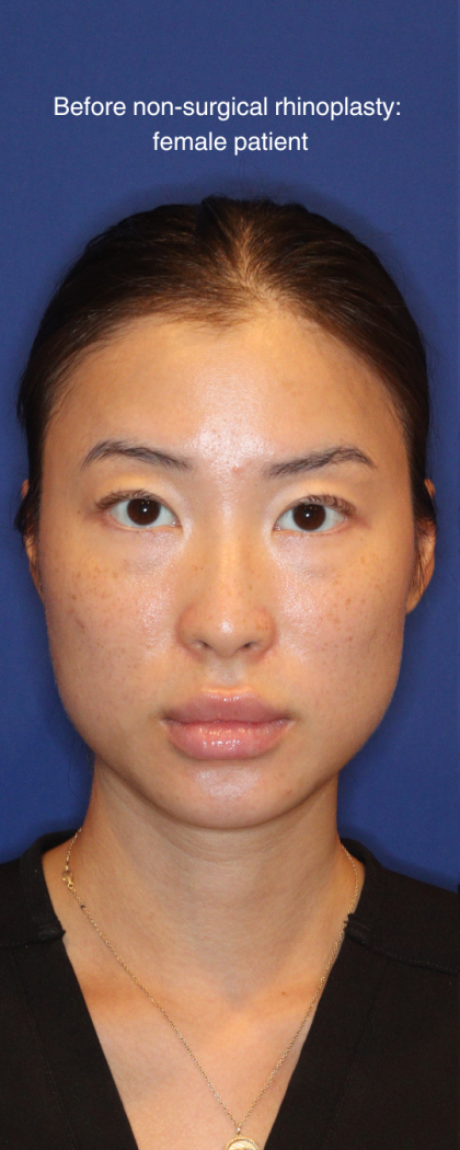 Non-Surgical Nose Job Before & After Patient #16752