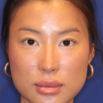 Non-Surgical Nose Job Before & After Patient #16752