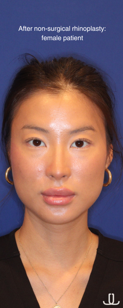 Non-Surgical Nose Job Before & After Patient #16752