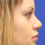 Rhinoplasty Before & After Patient #16814