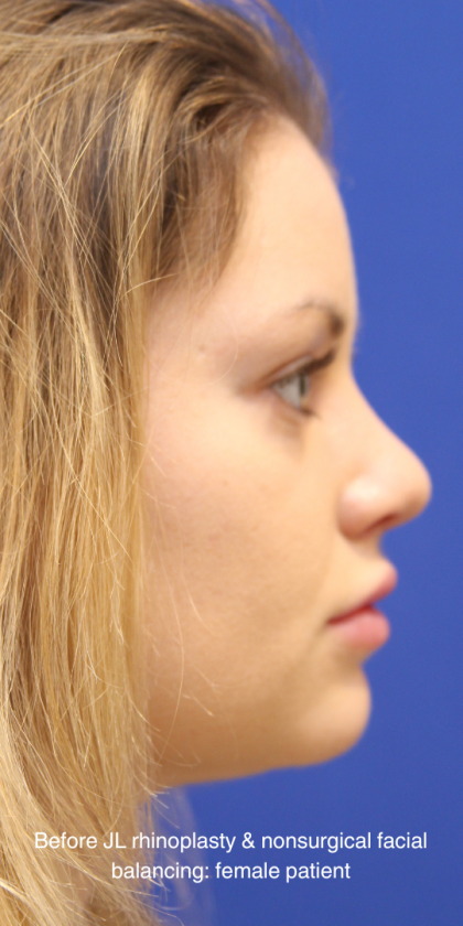 Rhinoplasty Before & After Patient #16814